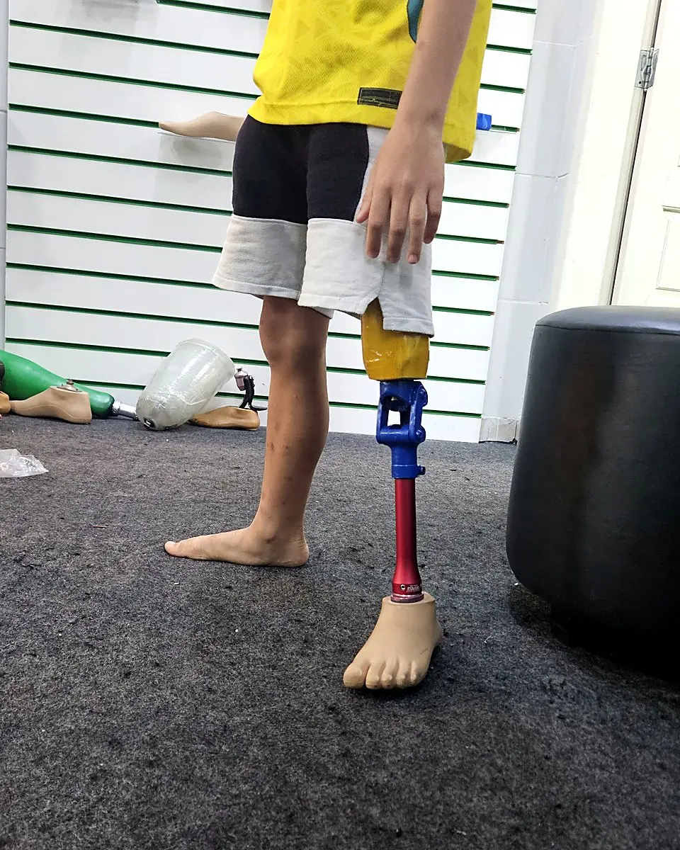 Criança em pé com prótese de perna colorida